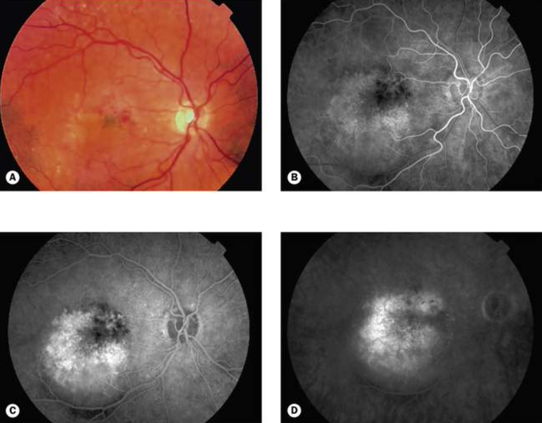 Degeneração Macular Relacionada à Idade DMRI Blog da Oftalmomaster