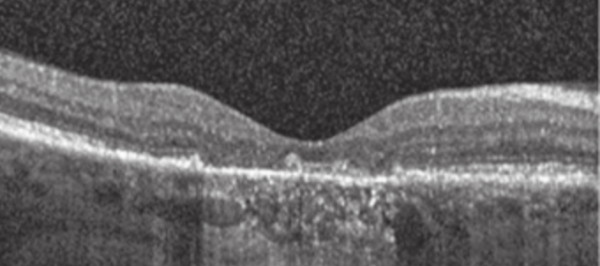 Degeneração Macular Relacionada à Idade DMRI Blog da Oftalmomaster