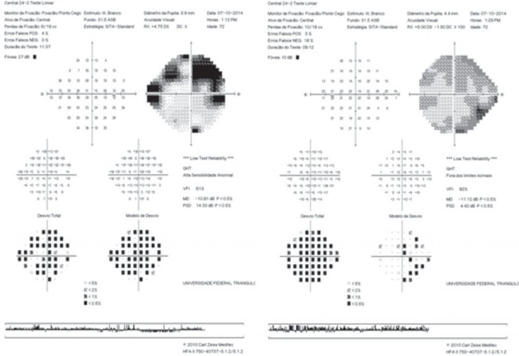Guia prático para interpretação do campo visual Humphrey Blog da Oftalmomaster