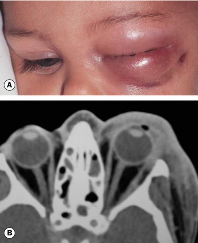 Celulite Pré-Septal (Periorbitária): o que é, como diagnosticar e tratar