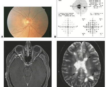 Neurite óptica campimetria, fundoscopia e ressonância magnética