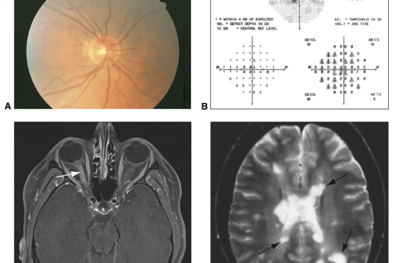 Neurite óptica campimetria, fundoscopia e ressonância magnética